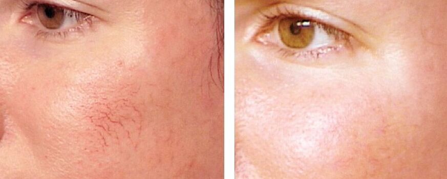 Pag -alis ng Rosacea