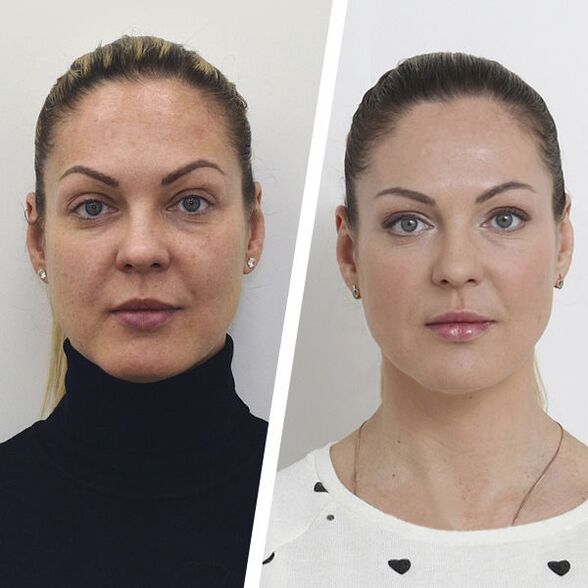 Bago at pagkatapos ng facial skin rejuvenation nang walang operasyon