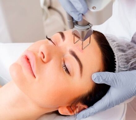 ang kakanyahan ng fractional laser facial skin rejuvenation procedure