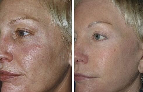 fractional laser rejuvenation bago at pagkatapos ng mga larawan