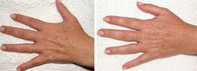 Resulta ng pag-alis ng mga pigment spot sa mga kamay